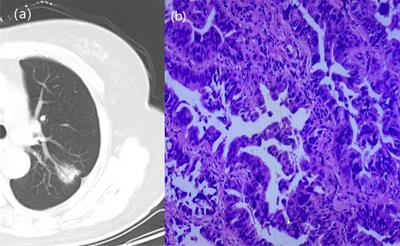 CT imaging indications correlate with the degree of lung adenocarcinoma infiltration